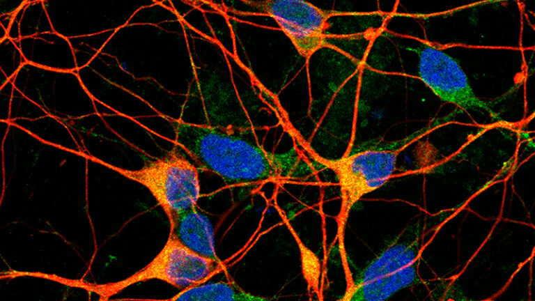 Alzheimer neuronas 8agosto2025